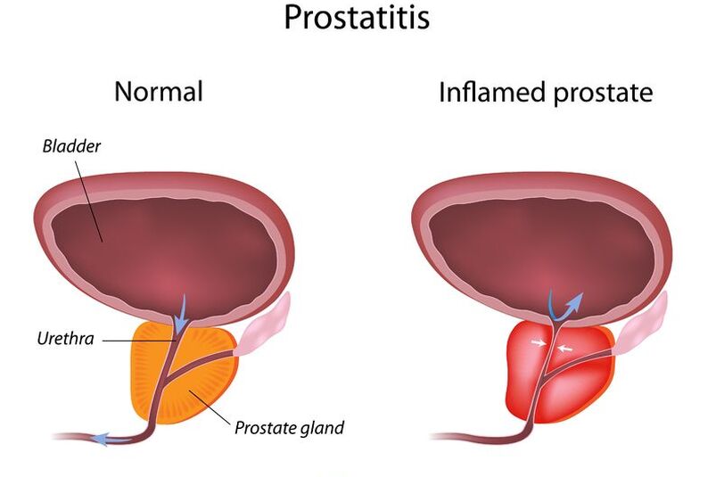a prostatitis chaga kezelése