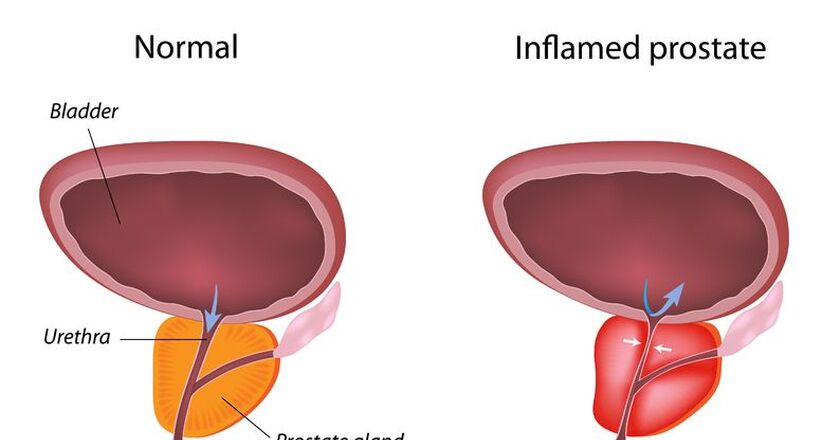 cáncer de próstata en la vejez cum se face clisme pentru prostatită