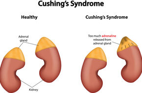 Syndrom zespołu Cushinga