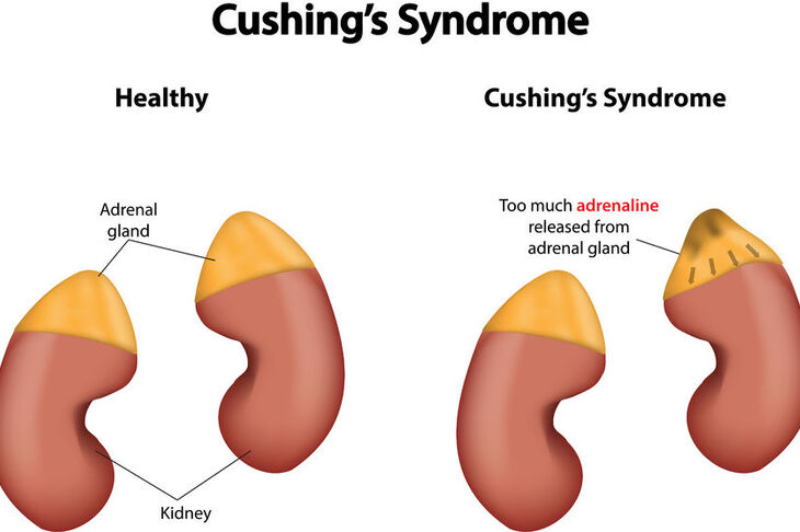 Syndrom zespołu Cushinga