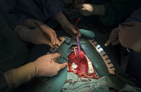 Czterech chirurgów wykonujących operację na otwartym brzuchu