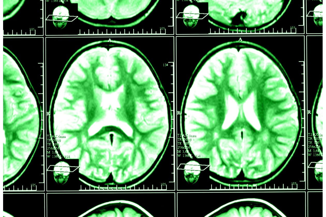 Badanie tomografia komputerowa mózgu