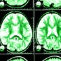 Badanie tomografia komputerowa mózgu