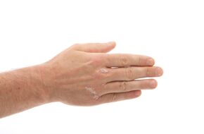 Dłonie z białymi zmianami skórnymi