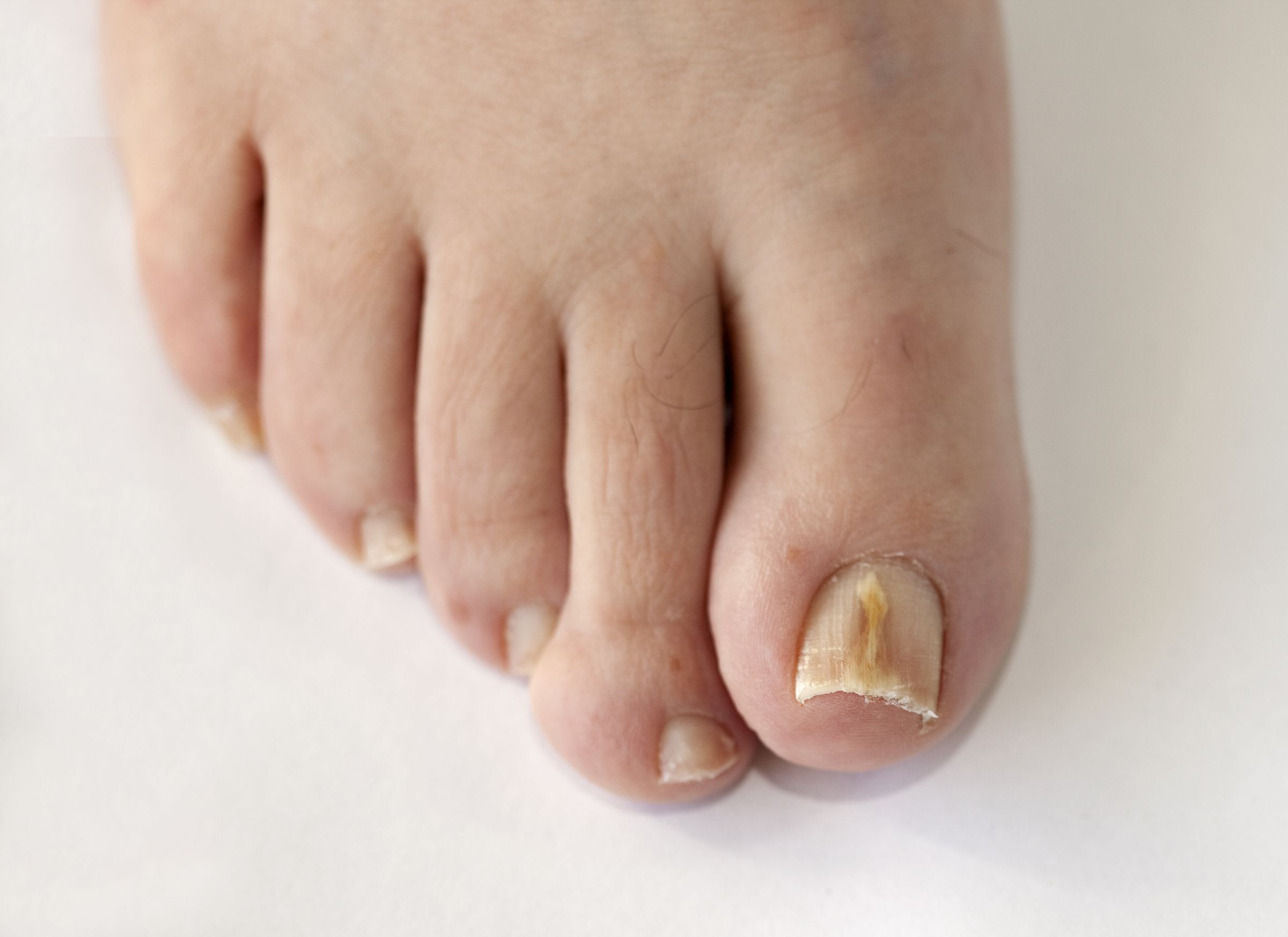 zolte paznokcie przyczyny i zapobieganie zel zmiekczajacy skorki pedzel do zdobien neonail