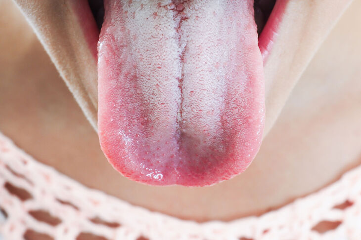 Bolący język