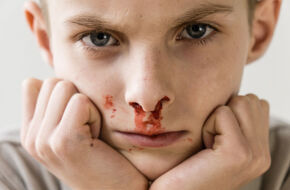 Chłopiec z krwotokiem z nosa