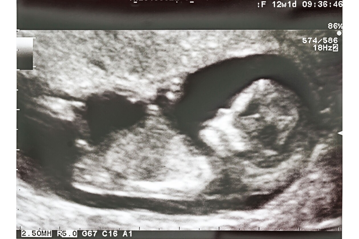 Płód widoczny na zdjęciu USG
