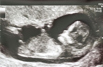 Płód widoczny na zdjęciu USG