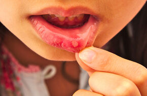 Zapalenie w jamie ustnej