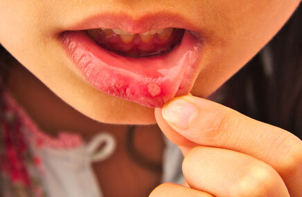 Zapalenie w jamie ustnej